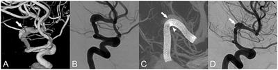 Anterior Circulation Fusiform Aneurysms Have a Lower Occlusion Rate After Pipeline Embolization Device Treatment Than Posterior Circulation Fusiform Aneurysms: A Multicenter Cohort Study